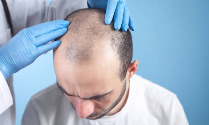زراعة الشعر في دبي