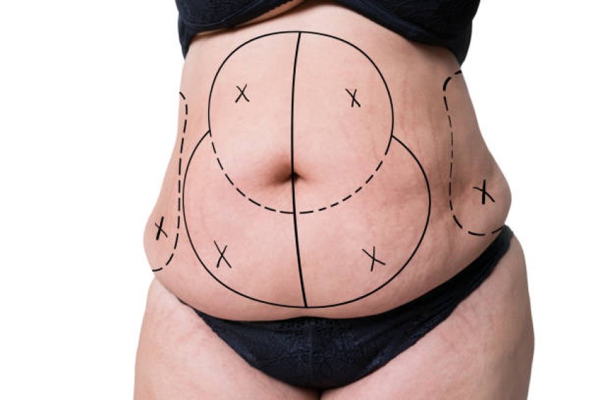 Circumferential Abdominoplasty in Dubai