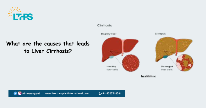 What are the causes that leads to Liver Cirrhosis?