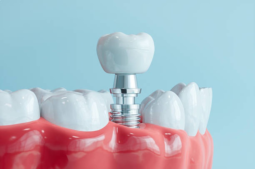Dental Implants
