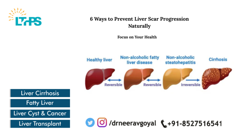 6 Ways to Prevent Liver Scar Progression Naturally