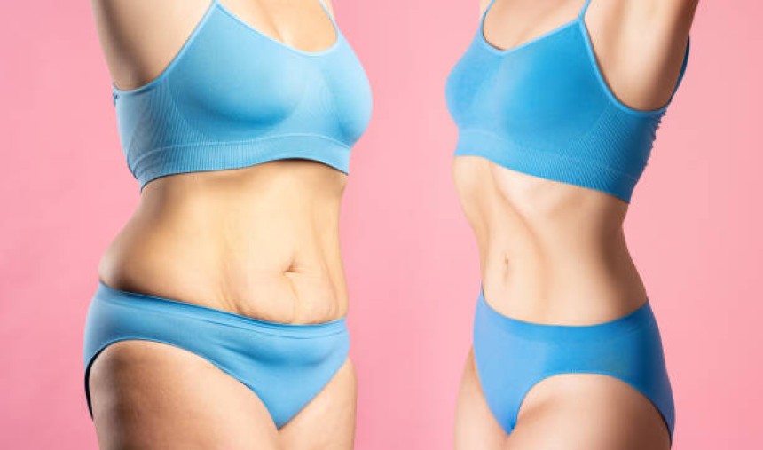 Liposuction in Riyadh