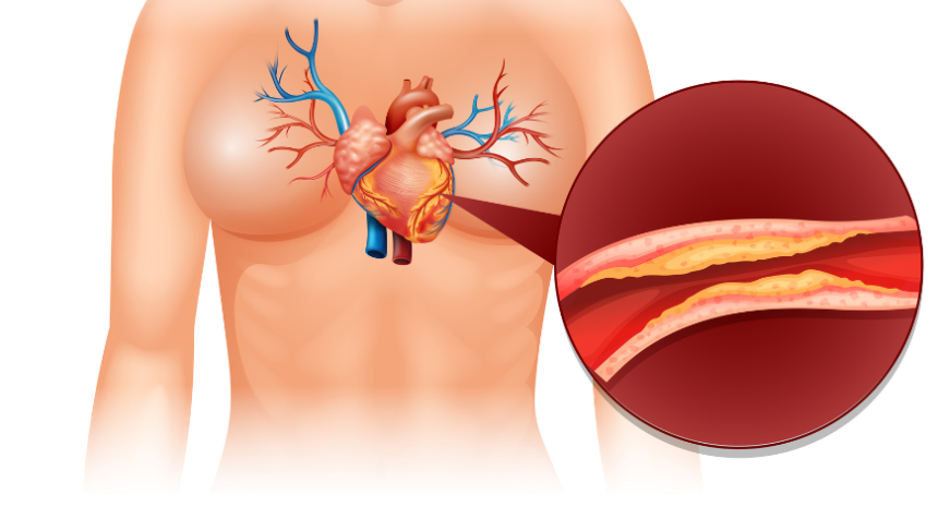 CT coronary angiography illustration showing blocked coronary artery and plaque buildup in the heart blood vessels