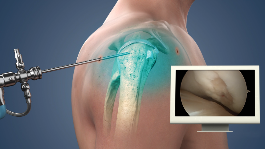 Shoulder Surgery in Michigan