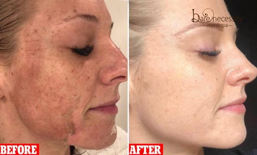 dermaplaning scottsdale az