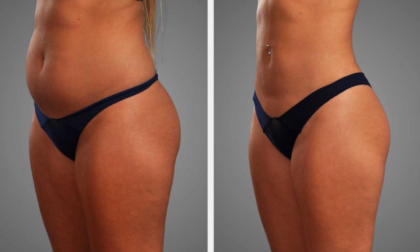 Liposuction in Islamabad
