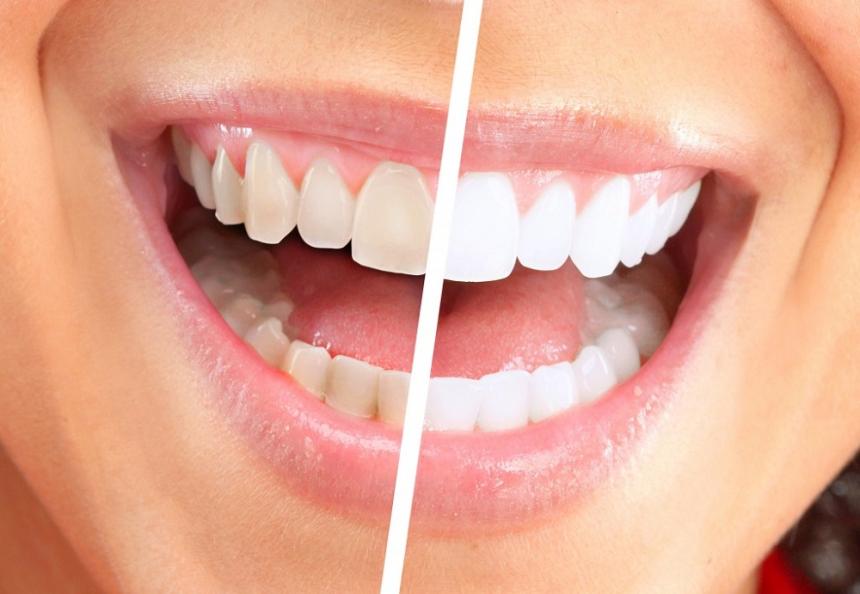 Dental Cleaning in Cudahy