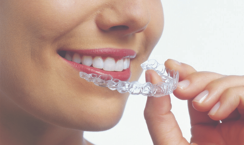 Clear Aligners Treatment in Bikaner