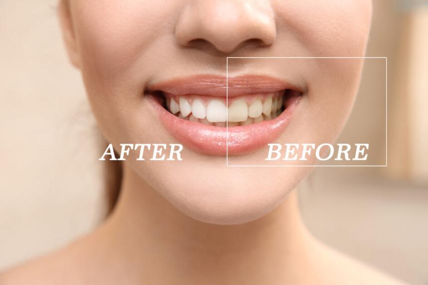 Top Teeth Whitening Services in Cudahy for a Brighter Smile