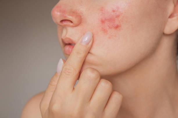 Can Laser Acne Scar Treatment Improve Overall Skin Quality