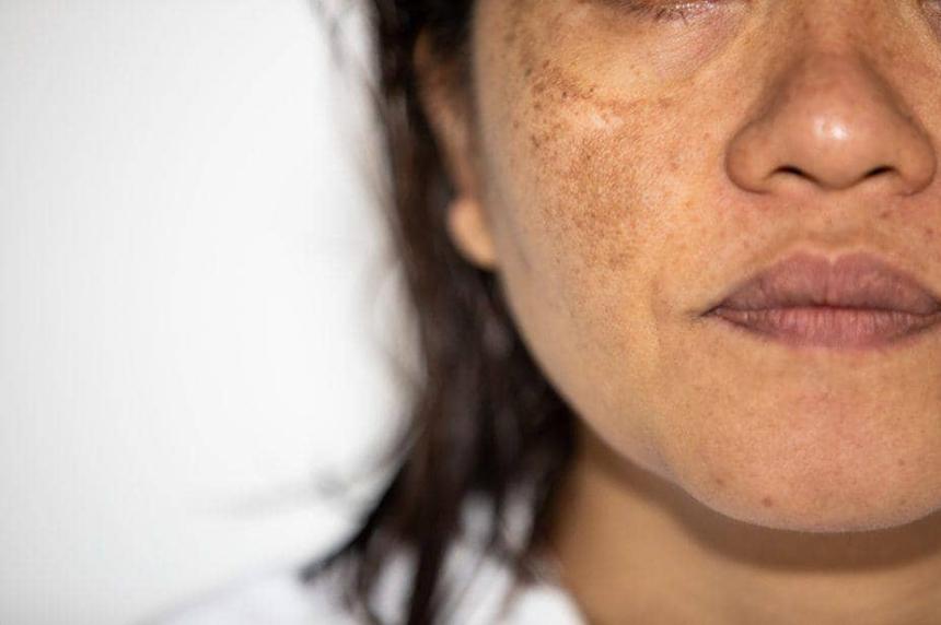 Can Melasma Treatment Improve Skin Clarity Over Time