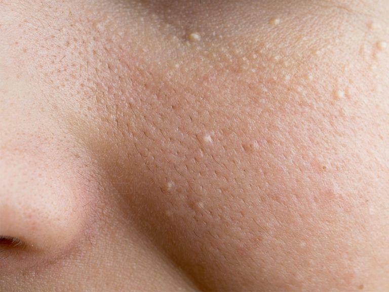 How Safe Is Modern Milia Treatment for All Skin Types?