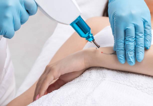 Can Tattoo Removal Help Achieve Clearer Skin Again