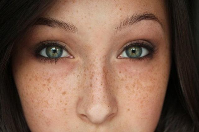 How Fast Does Freckles and Blemishes Treatment Work?