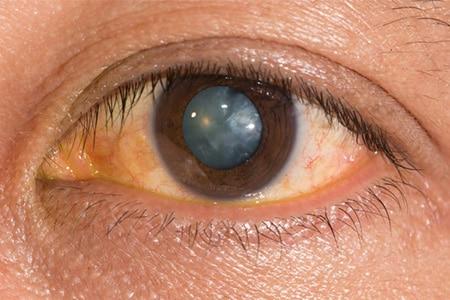 Laser for Vision Correction for Clearer Sight and Greater Freedom