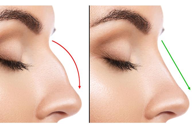 How long does rhinoplasty surgery take?