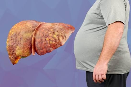 Fatty Liver Disease: Causes, Stages, and Warning Signs