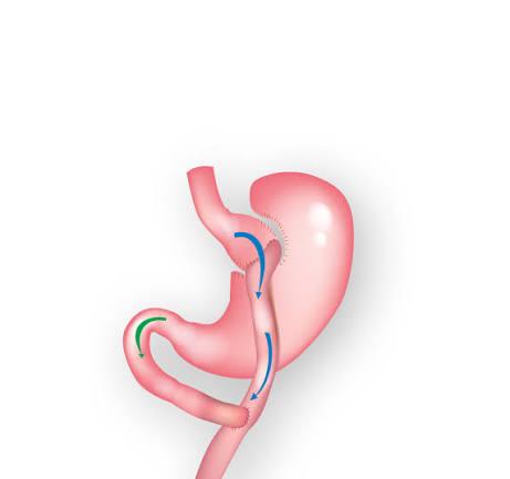 Gastric bypass surgery
