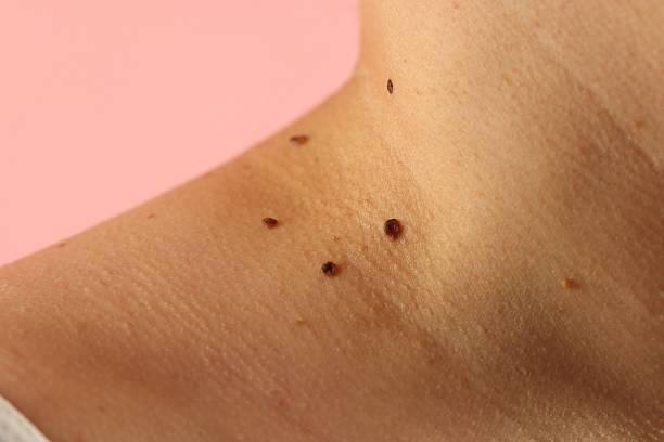 Is Skin Tag Removal Effective for Facial Skin Tags