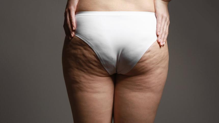 What Are the Key Benefits of Cellfina Treatment?