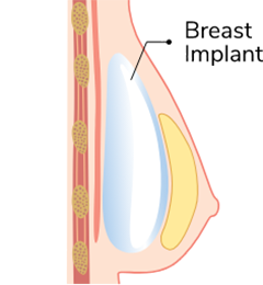 What to Expect During Breast Augmentation Surgery: A Step-by-Step Guide