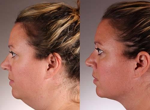 Combating Menopausal Skin Thinning with Autologous Repair