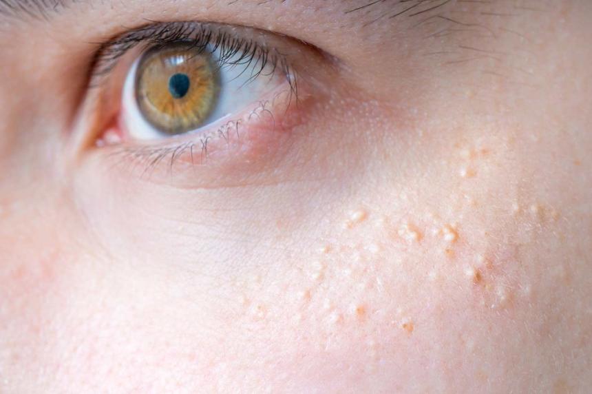 Are At Home Milia Treatment Methods Actually Effective?