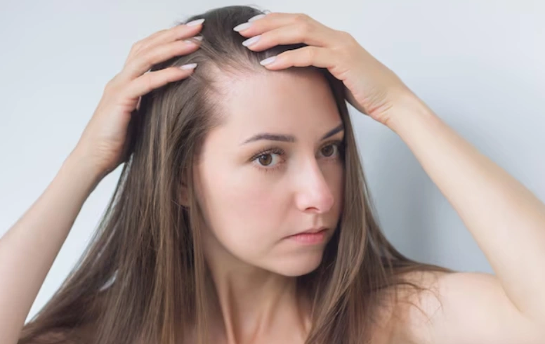 Female Pattern Hair Loss