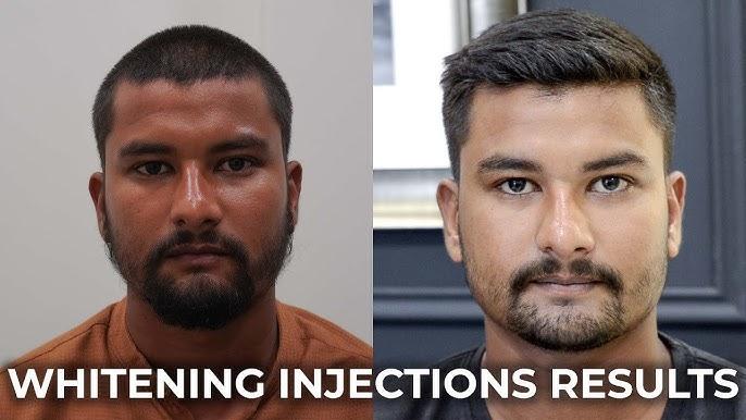 Miracle White Injection Benefits: Why It Is Popular Among Skincare Enthusiasts in Pakistan