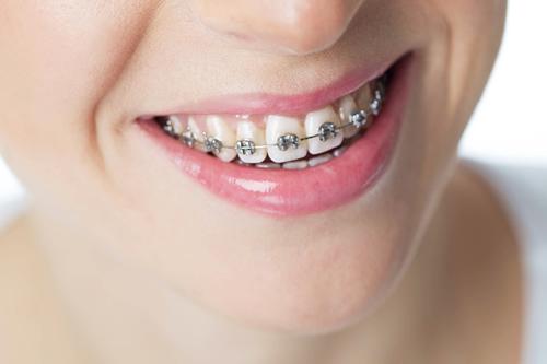 How Do Braces Help Correct Misaligned Teeth Effectively?