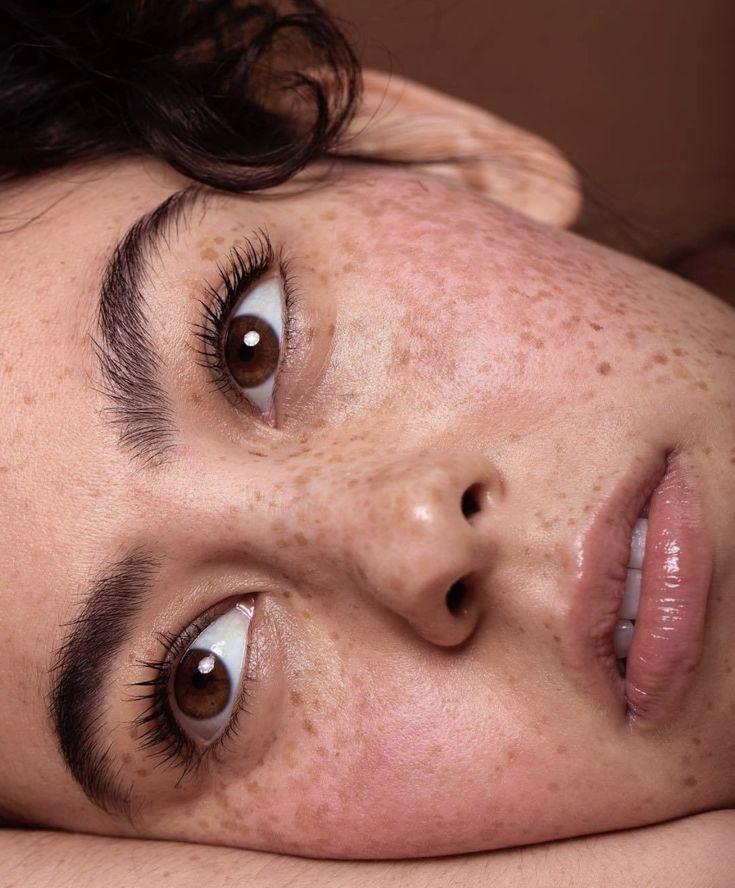 Why Choose Freckles and Blemishes Treatment for Skin?