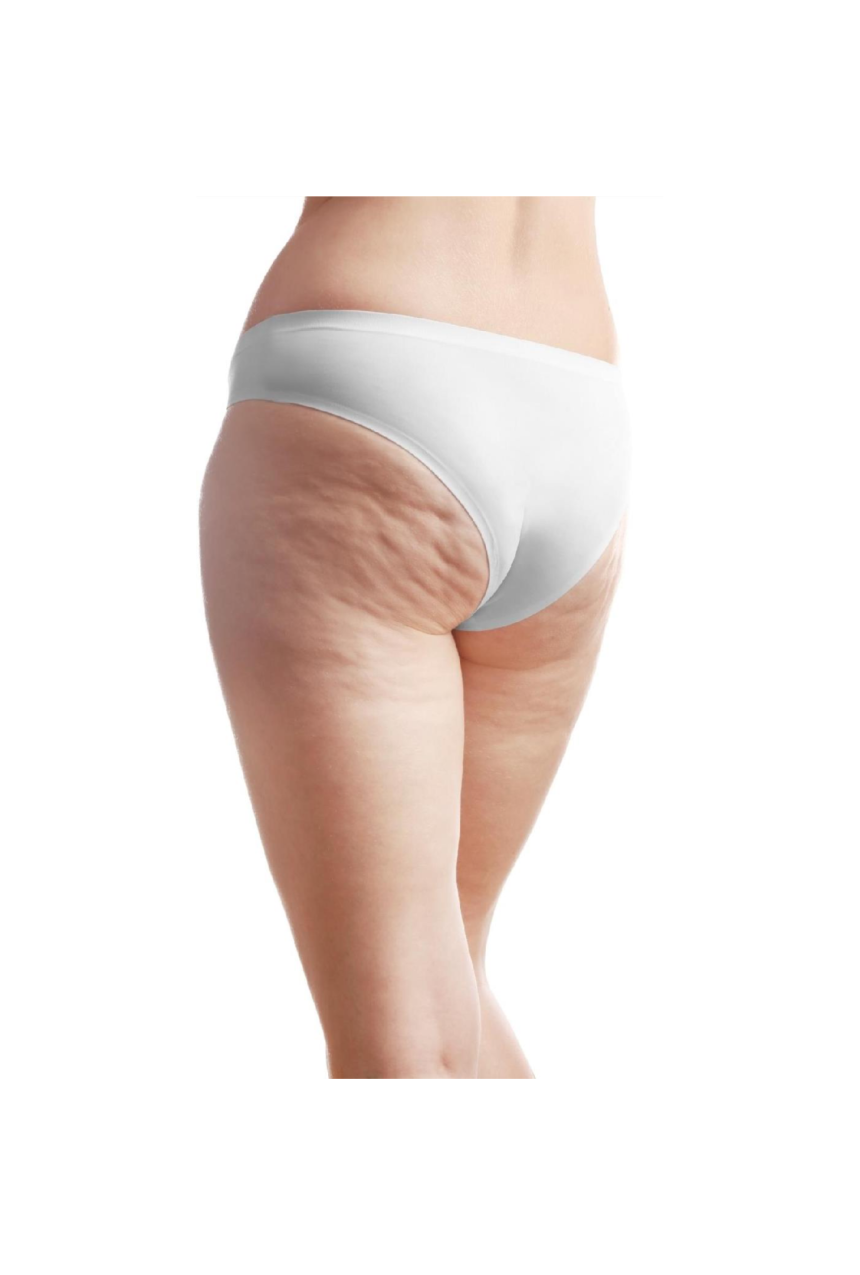 Does Cellfina Treatment Work Better Than Alternatives?